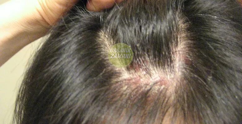 Платяные вши фото укусов на теле hautpflege panosundaki Pin