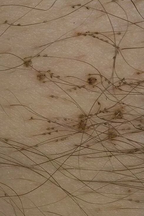 Платяные вши фото укусов на теле Лобковые вши: как выглядят и откуда берутся, симптомы появления, лечение