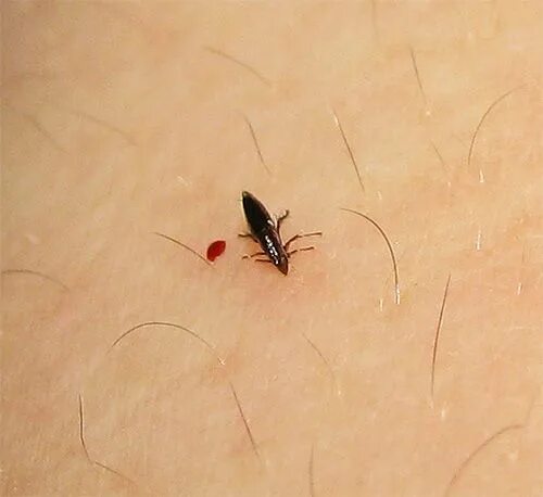 Платяные вши укусы на теле человека фото Блоха на теле человека в момент укуса. Блохи, Собаки