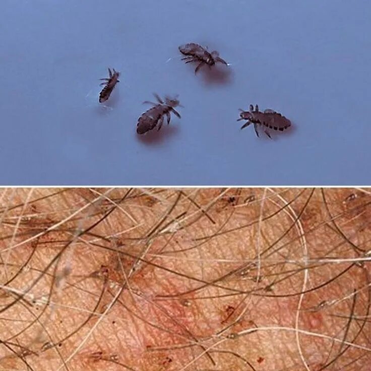 Платяные вши укусы на теле человека фото Pin på piqures d insectes