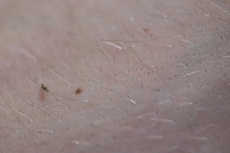 Платяные вши укусы на теле человека фото Incident, událost Vyhovět Škarpa tea tree oil na vši kukuřice Třetí faktor