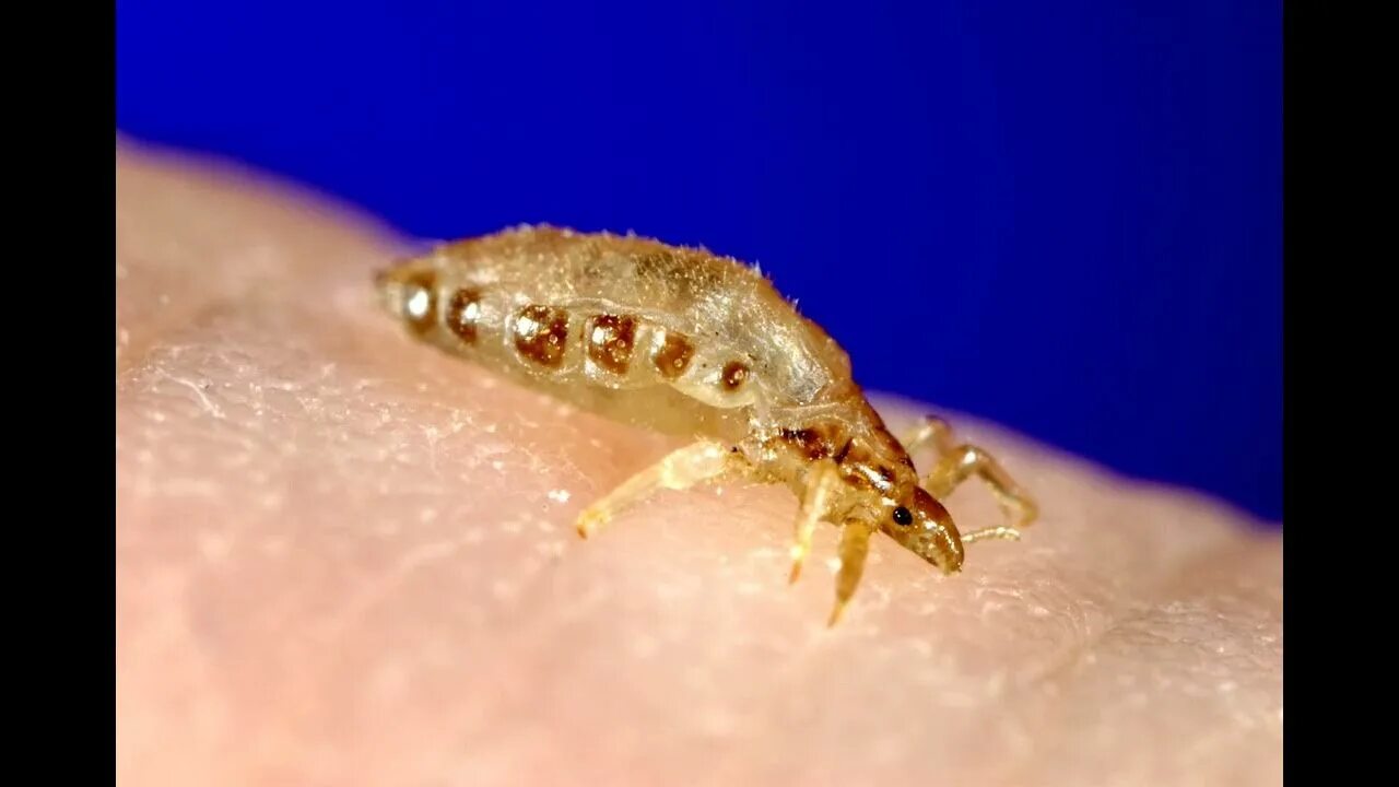 Платяные вши укусы на теле человека фото Твари окаянные рассказ о вшах из книги М.Козлова Не просто букашки - YouTube