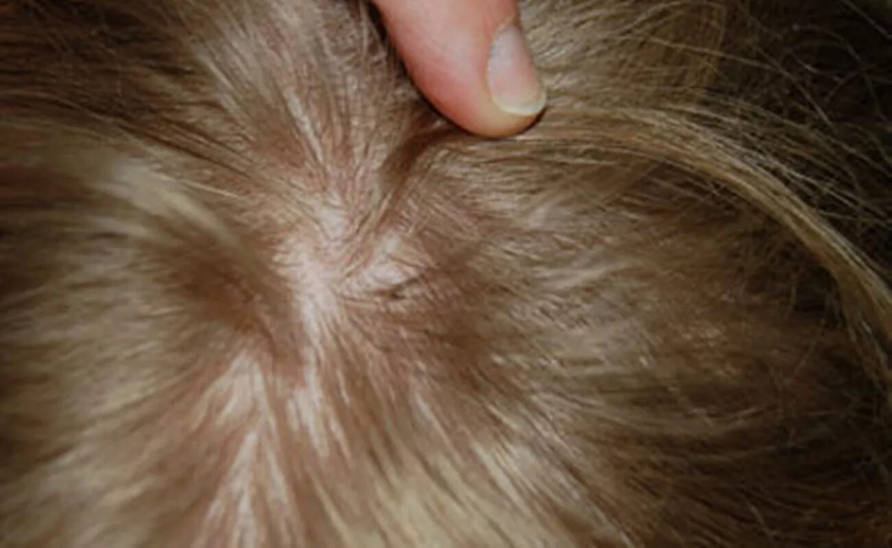 Платяные вши укусы на теле человека фото 2 mitos comunes sobre los piojos - Eliminar Plagas