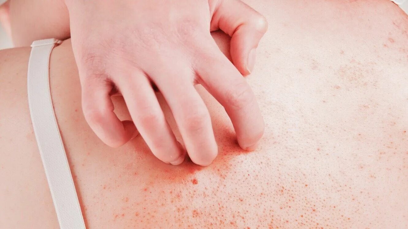Пленочный дерматит фото 20 Signs of An Autoimmune Disorder (And How To Reverse It)