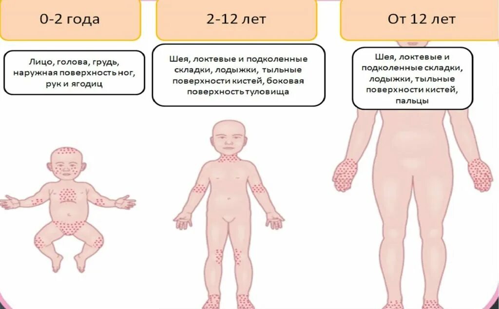 Пленочный дерматит у ребенка на попе фото Аллергический дерматит у детей: фото, признаки и лечение