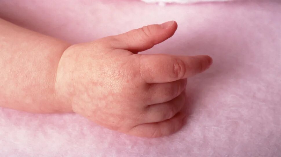 Пленочный дерматит у ребенка на попе фото National Maternity Services Framework facing a difficult birth Australian Medica