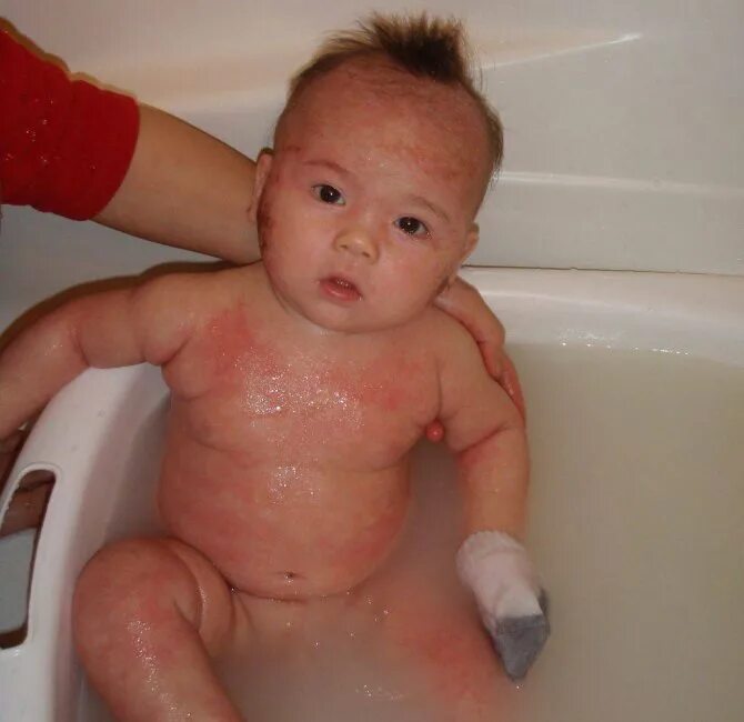 Пленочный дерматит у ребенка на попе фото Food allergies in infants: photos, treatment and symptoms in newborns up to one 