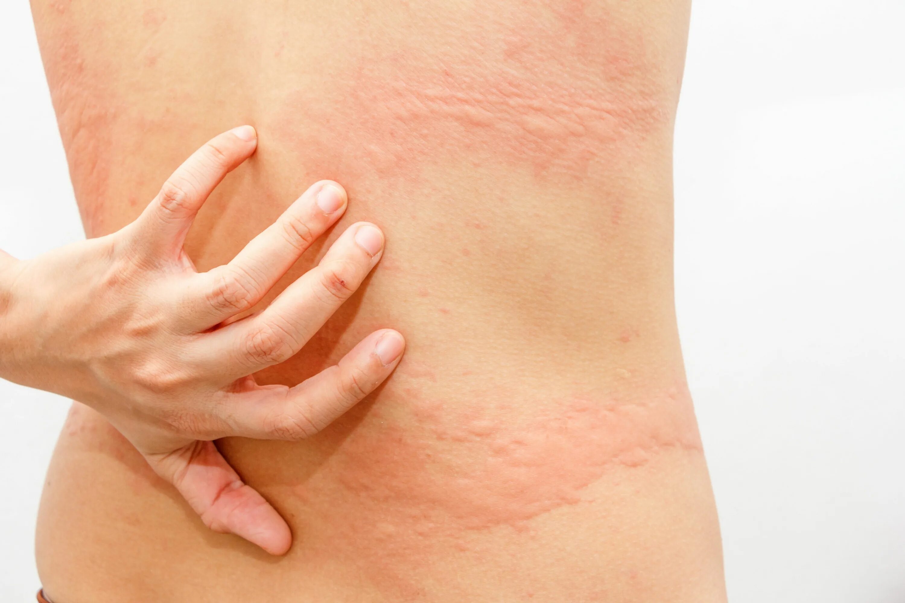 Пленочный дерматит у ребенка в паху фото Dupilumab Significantly Decreased Itch and Hives in Patients with Chronic Sponta