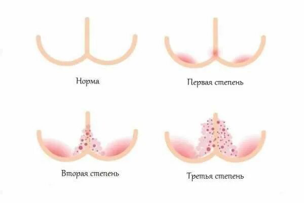 Пленочный дерматит у ребенка в паху фото Пеленочный дерматит: причины, симптомы и лечение в статье аллерголога Столярова 