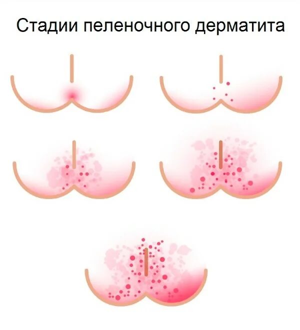 Пленочный дерматит у ребенка в паху фото Использование подгузников и профилактика пеленочного дерматита - "Интернет-кабин