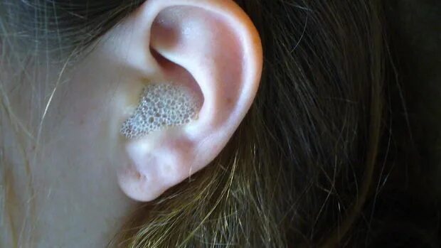 Плесень в ухе фото EAR SPA - 2 - English Hydrogen peroxide uses, Cleaning your ears, Hydrogen perox