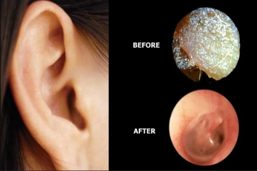 Плесень в ухе фото The ears are one of the main organs that provide us with the ability to listen a