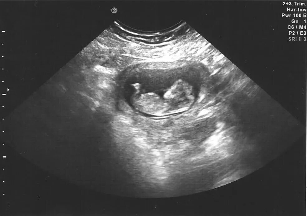 Плод 10 11 недель фото In Colombia, a girl was born, "pregnant" with her own twin . A resident of Colom