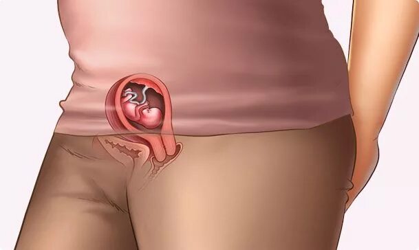 Плод 10 11 недель фото 10 weeks pregnant 10 weeks pregnant, Pregnancy week by week, Pregnancy early
