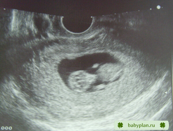 Плод 10 11 недель фото 11 недель-растём не по дням, а по часам! - УЗИ - BabyPlan.ru