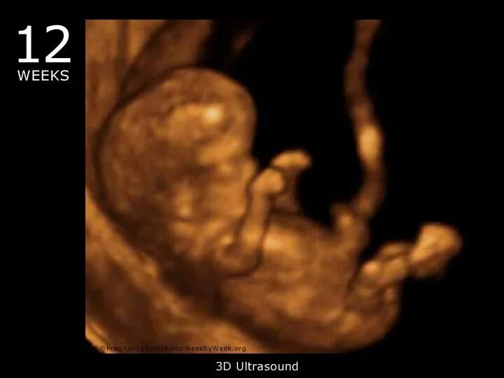 Плод 12 недель фото узи 12 Weeks Pregnant ─ Pregnancy Symptoms 12 weeks pregnant ultrasound, 12 weeks pr