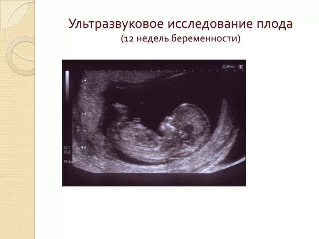 Плод 12 недель фото узи Узи плода по неделям беременности