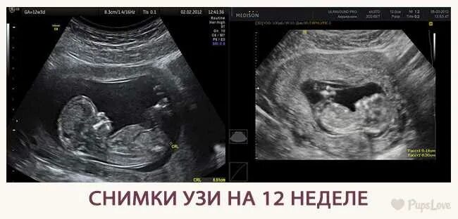 Плод 12 недель фото узи Двенадцатая неделя беременности акушерская: что происходит, фото живота, узи пло