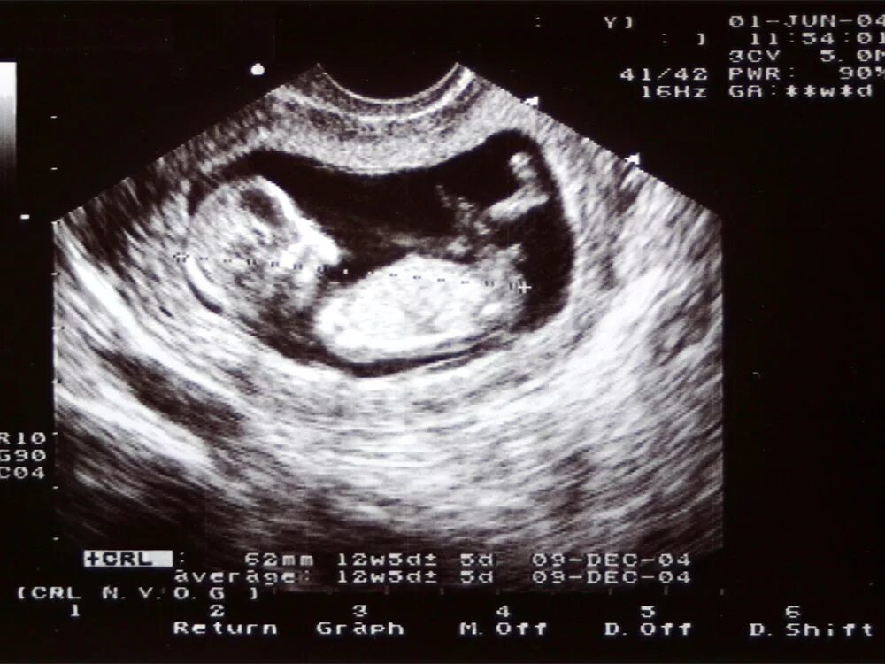 Плод 12 недель фото узи 12 Week 6 Day Ultrasound on Sale www.beztabaka.by