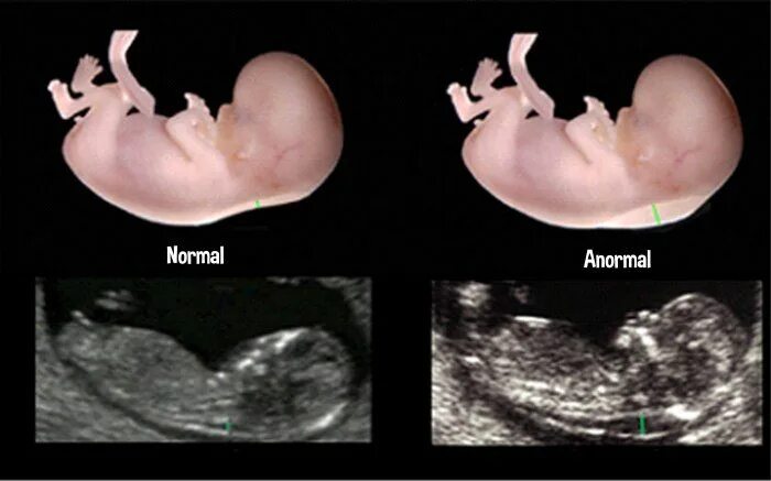 Плод 12 недель фото узи Translucência Nucal - Quais os Valores Normais? Imagens de ultrassom, Material d