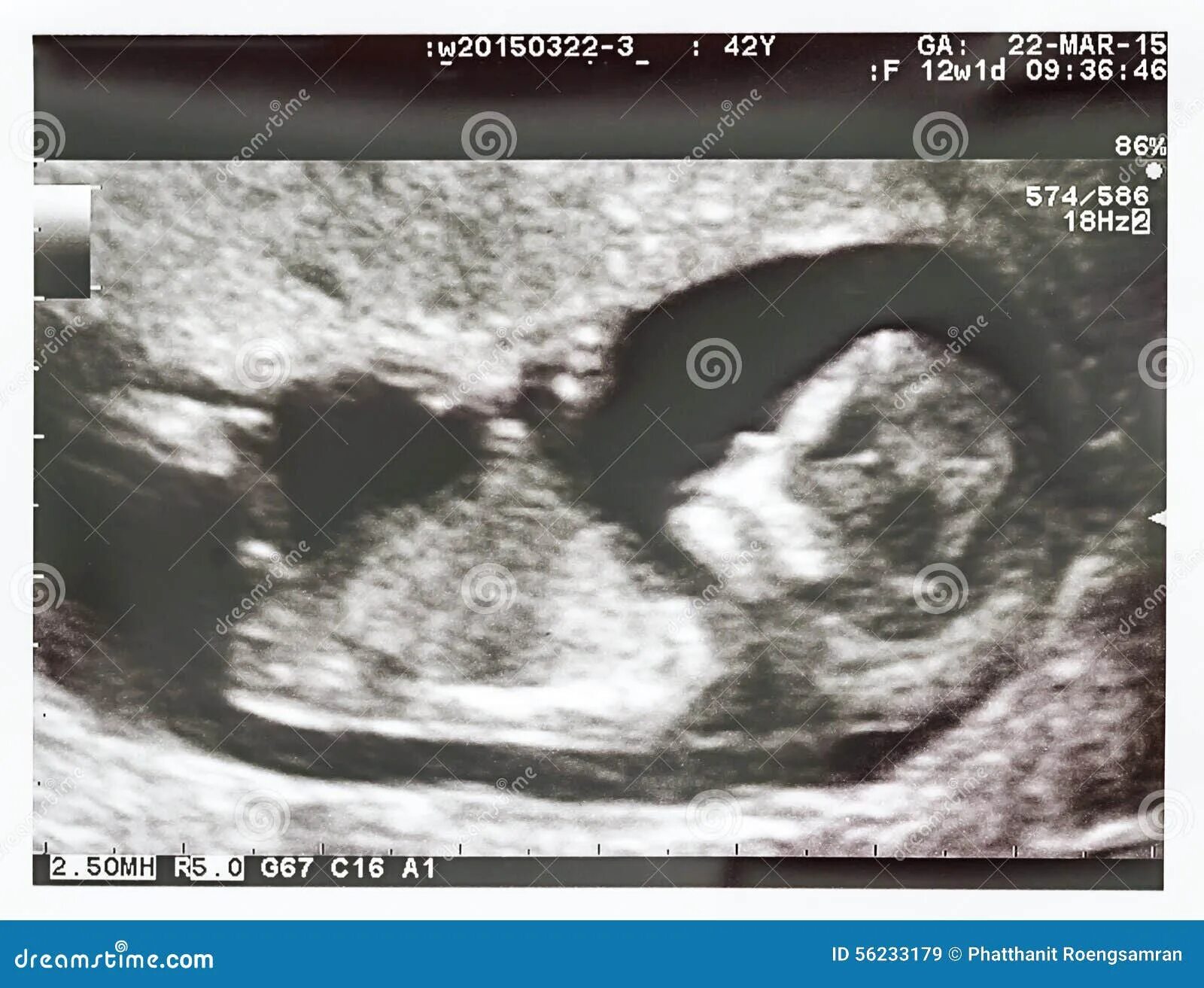 Плод 12 недель фото узи Ultrasound Fetus 12 Weeks Photos - Free & Royalty-Free Stock Photos from Dreamst