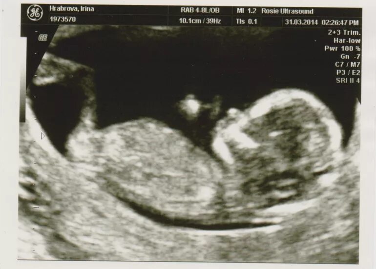 Плод 12 недель фото узи Что пишут мамы на 14 неделе беременности - Форум BabyBlog - отзывы уже беременны