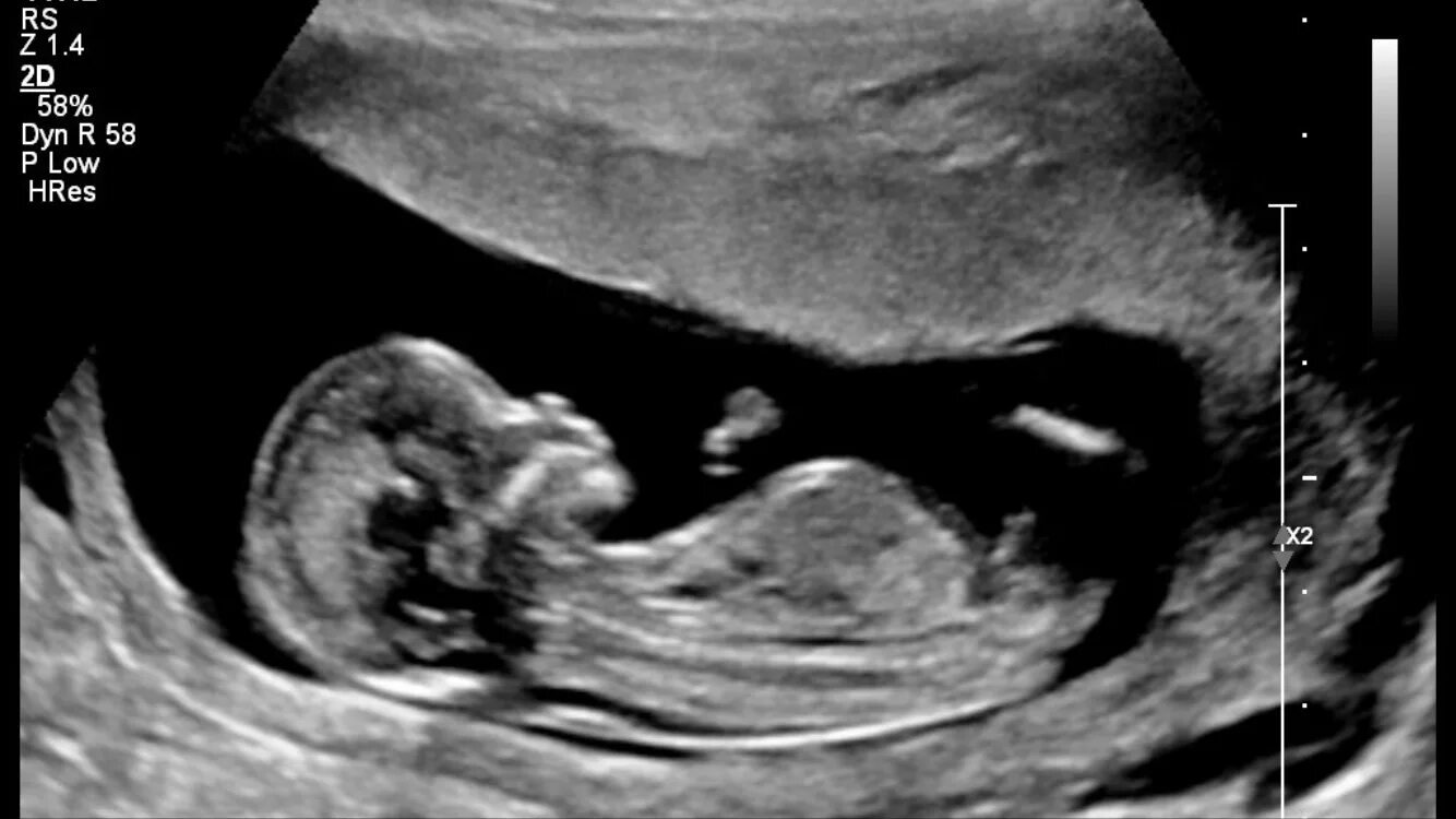 Плод 13 недель фото узи Twins ultrasound 13 weeks