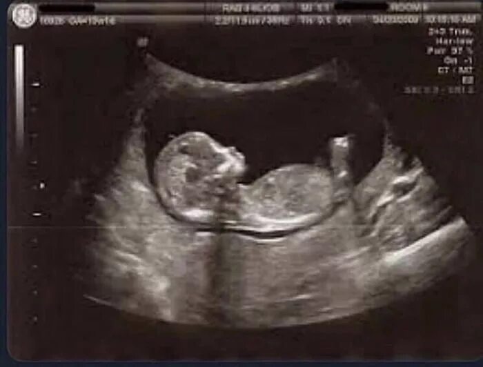 Плод 13 недель фото узи The last time people were excited to see me. - 9GAG