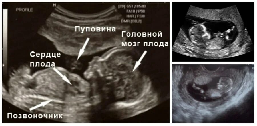 Плод 13 недель фото узи Скрининг 1 триместра: когда и как делают, сроки проведения, нормы и расшифровка 