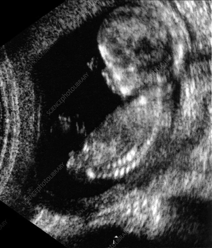 Плод 13 недель фото узи Foetus at 13 weeks, ultrasound - Stock Image - C001/5207 - Science Photo Library