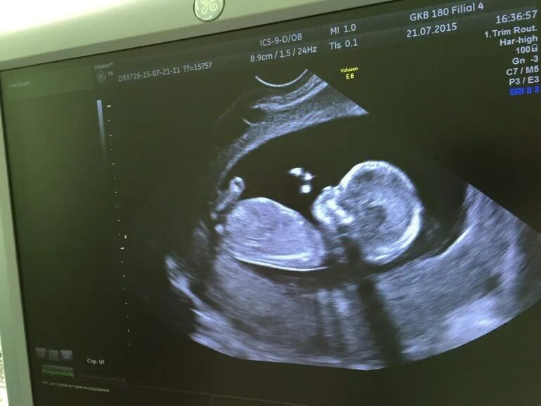 Плод 13 недель фото узи Моя малявочка... - 11 ответов форум Babyblog