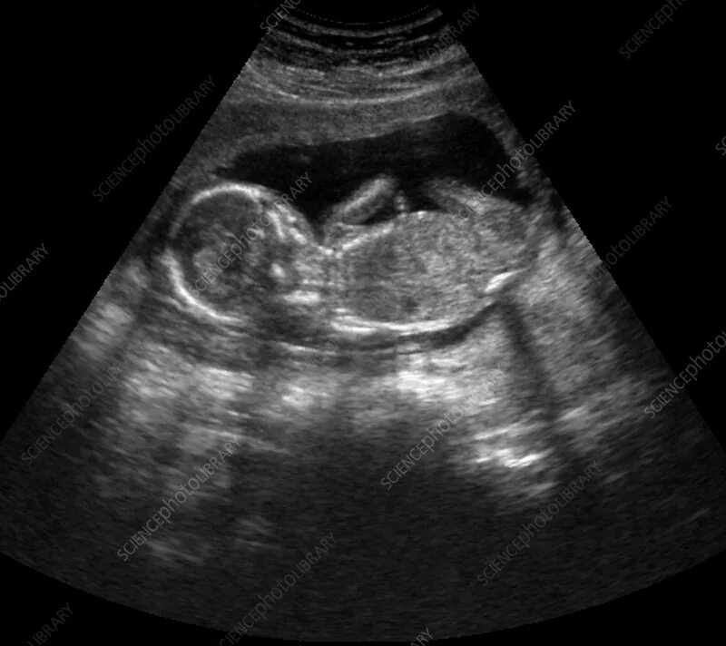 Плод 15 неделя фото Foetus at 15 weeks, ultrasound - Stock Image - C003/5006 - Science Photo Library