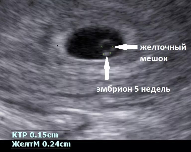 Плодное яйцо 6 недель фото Картинки ПРИ КАКОМ РАЗМЕРЕ ПЛОДНОГО ЯЙЦА ВИДНО ЭМБРИОН