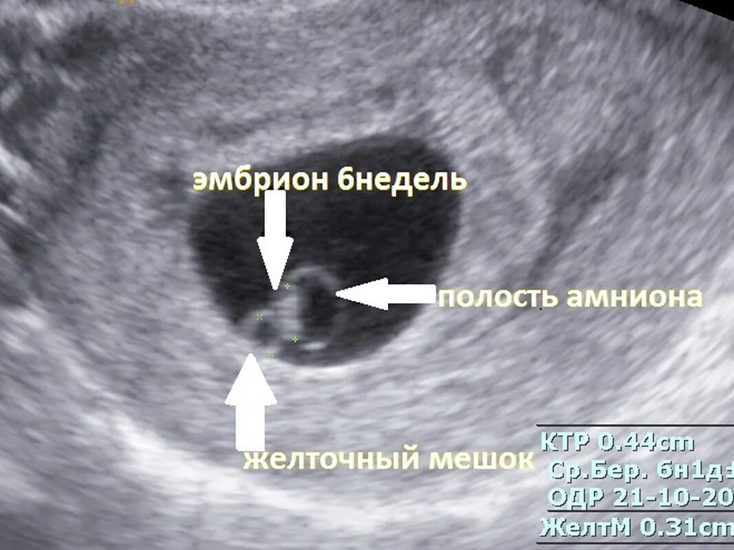 Плодное яйцо 6 недель фото Картинки ПРИ КАКОМ РАЗМЕРЕ ПЛОДНОГО ЯЙЦА ВИДНО ЭМБРИОН