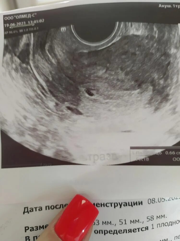 Плодное яйцо 6 недель фото УЗИ 3-4 недели, беременность под вопросом - 22 ответов форум Babyblog