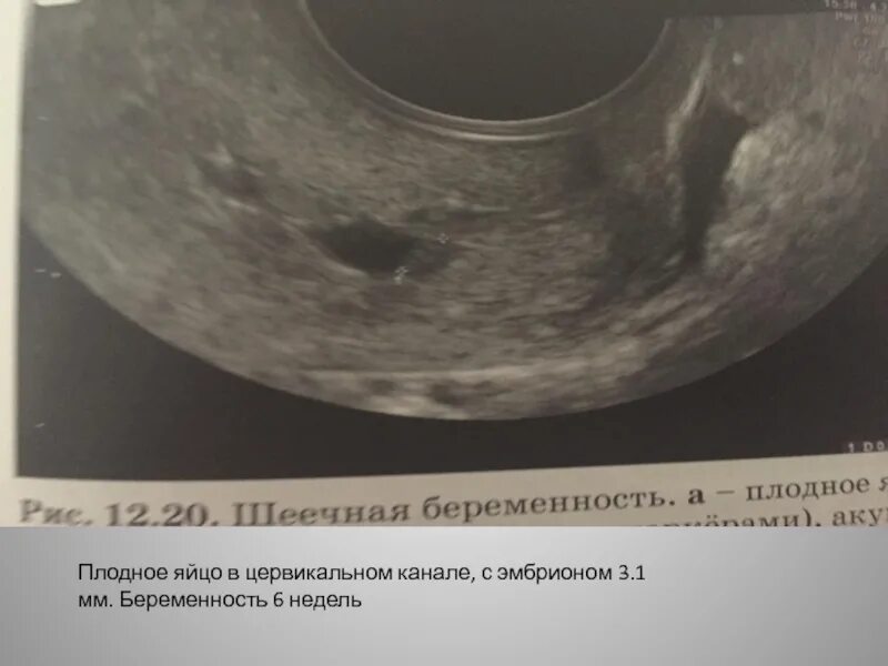 Плодное яйцо 6 недель фото Картинки ПРИ КАКОМ РАЗМЕРЕ ПЛОДНОГО ЯЙЦА ВИДНО ЭМБРИОН