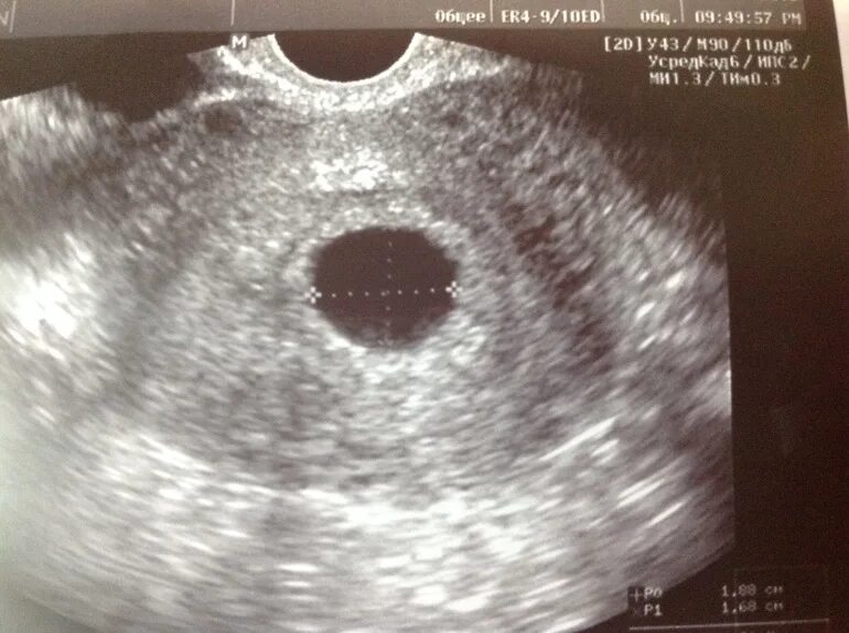 Плодное яйцо 6 недель фото Пустое плодное яйцо - 12 ответов форум Babyblog