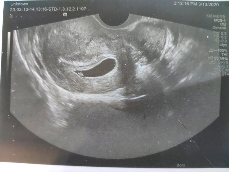 Плодное яйцо 6 недель фото У кого было большое плодное яйцо? - 20 ответов форум Babyblog