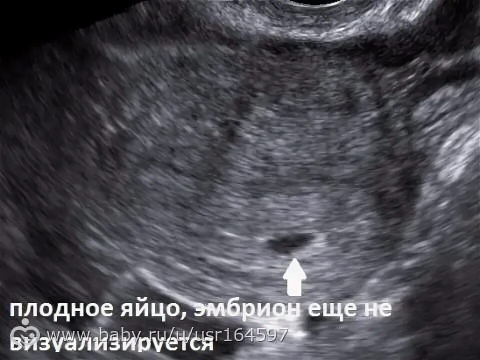 Плодное яйцо 6 недель фото Когда плодное яйцо видно на УЗИ?