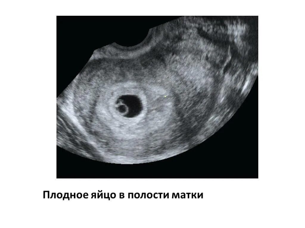 Плодное яйцо 6 недель фото Форум анэмбриония: Вопрос задает - Юлия,36Лет, - вопрос-ответ от специалистов кл