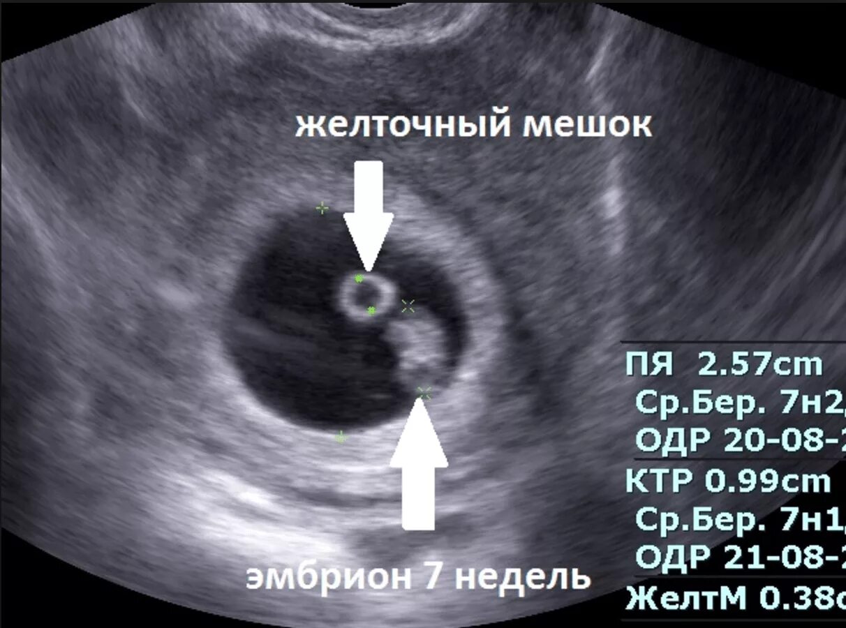 Плодное яйцо 6 недель фото Два эмбриона в одном плодном яйце - найдено 89 картинок