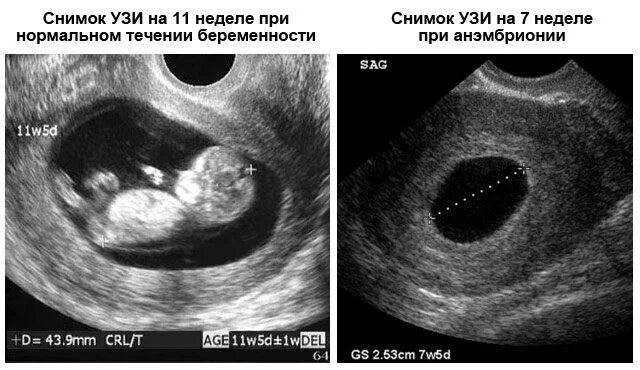 Плодное яйцо 6 недель фото Когда плодное яйцо видно на УЗИ?