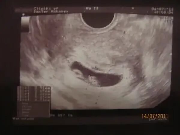 Плодное яйцо 6 недель фото Неправильной формы плодное яйцо - Здоровый ребенок