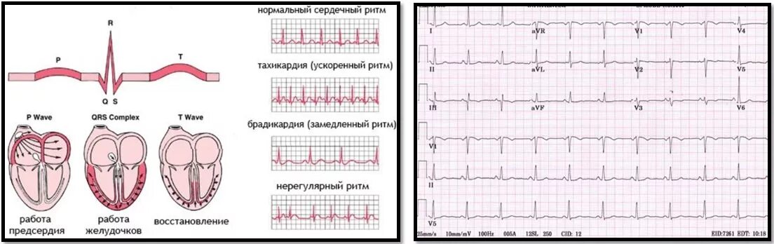 Плохая кардиограмма сердца фото Анализы для спортсмена: чекап для фитнеса и бодибилдинга