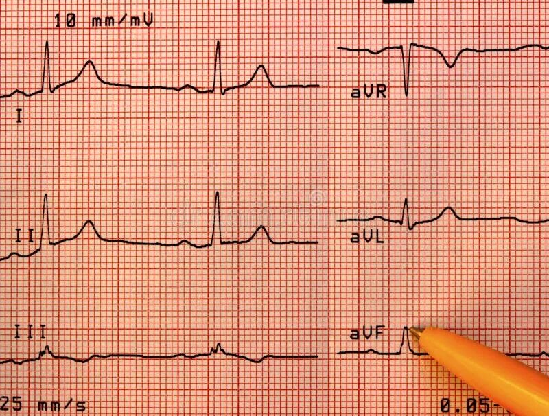 Плохая кардиограмма сердца фото An Abnormal Electrocardiogram Result Paper with a Little Yellow Candy Heart Stoc