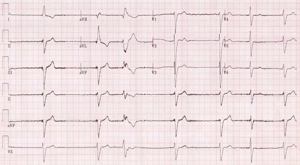 Плохая кардиограмма сердца фото AF with slow ventricular response AF with slow ventricular. Flickr
