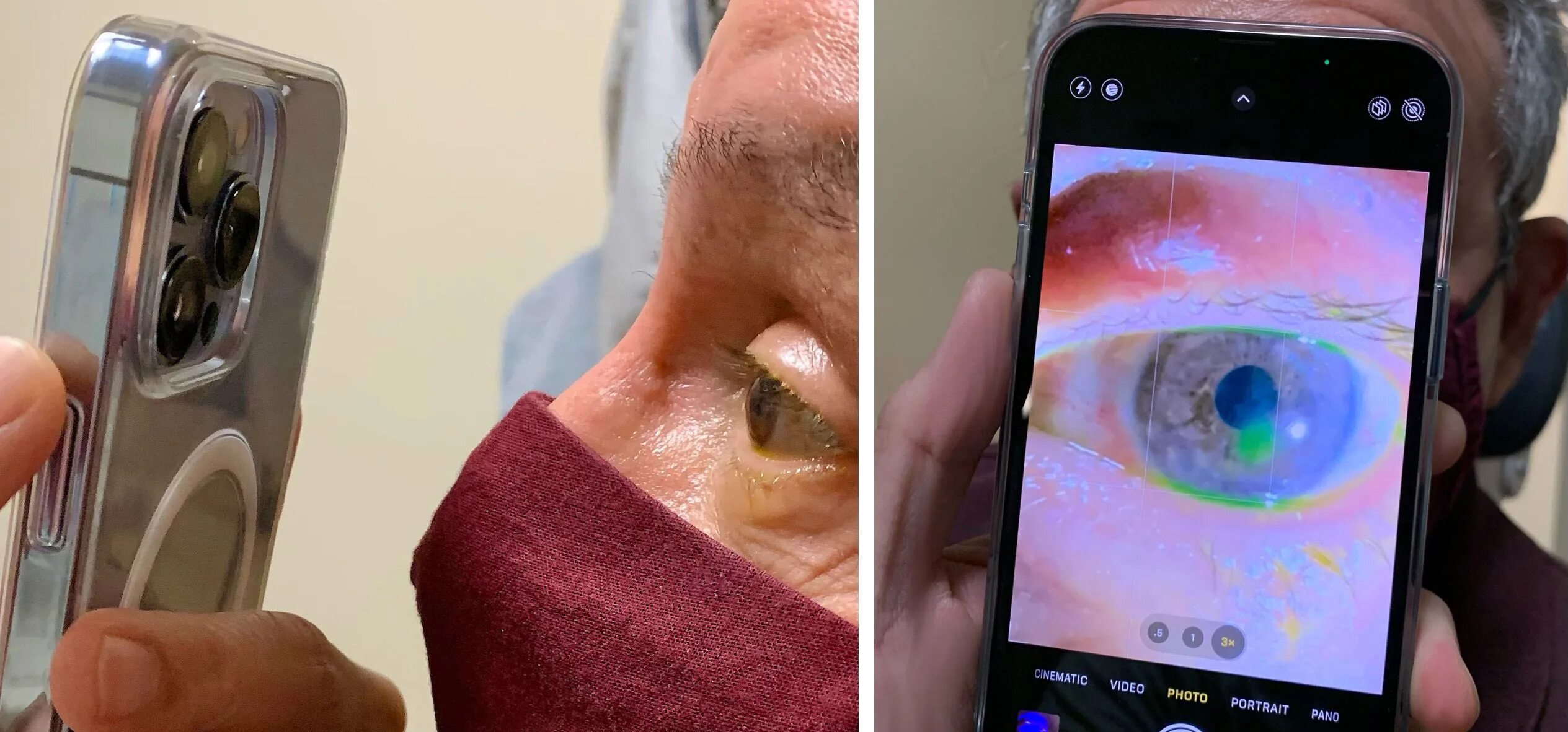 Плохие фото на айфон EyePhone: How one doctor is using the iPhone 13 Pro's macro capabilities to remo