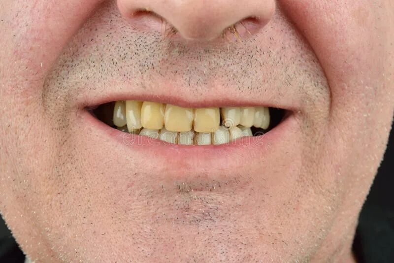 Плохие зубы фото Detailed Image of Man Showing His Teeth. Dental Health Care. Hygiene Teeth Stock
