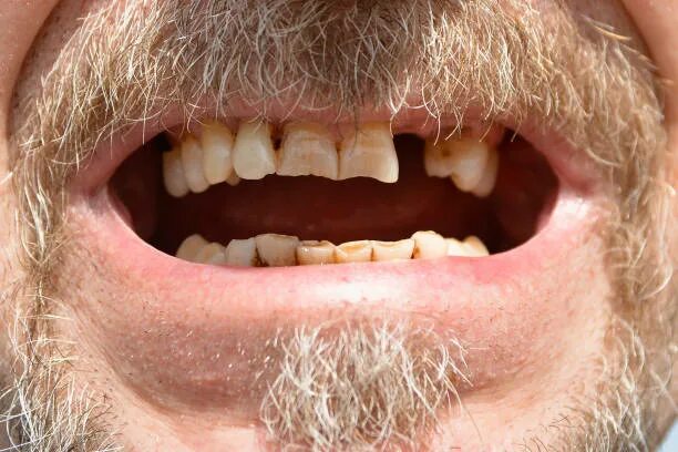 Плохие зубы фото Более 1 200 работ на тему "Man Missing Teeth": стоковые фото, картинки и изображ