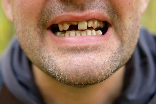 Плохие зубы фото Rotten Teeth Изображения: просматривайте стоковые фотографии, векторные изображе